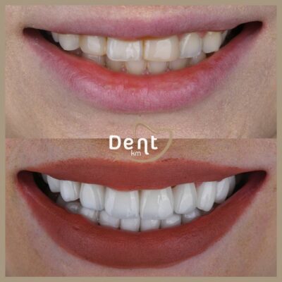 DentKM Before After EN 3